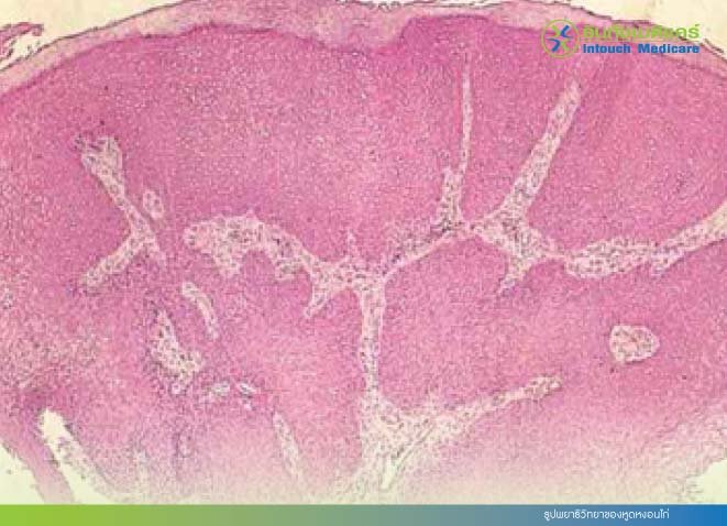 รูปพยาธิวิทยาของหูดหงอนไก่ รูปพยาธิวิทยาของหูดหงอนไก่