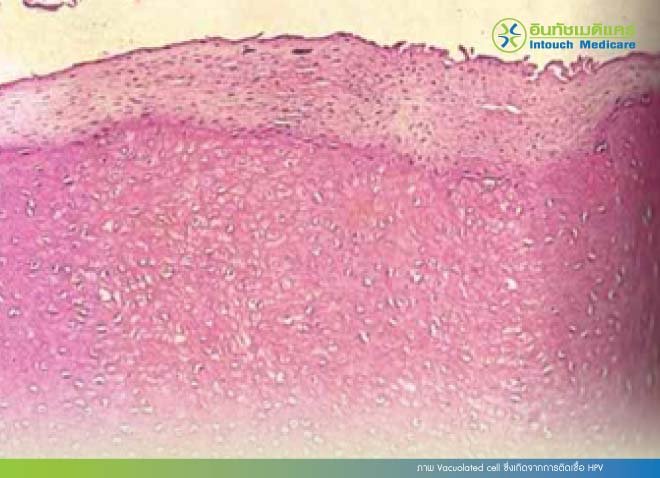 ภาพ Vacuolated cell ซึ่งเกิดจากการติดเชื้อ HPV