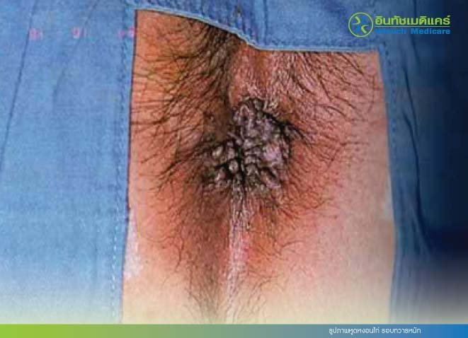 รูปภาพหูดหงอนไก่ รอบทวารหนัก รูปภาพหูดหงอนไก่ รอบทวารหนัก