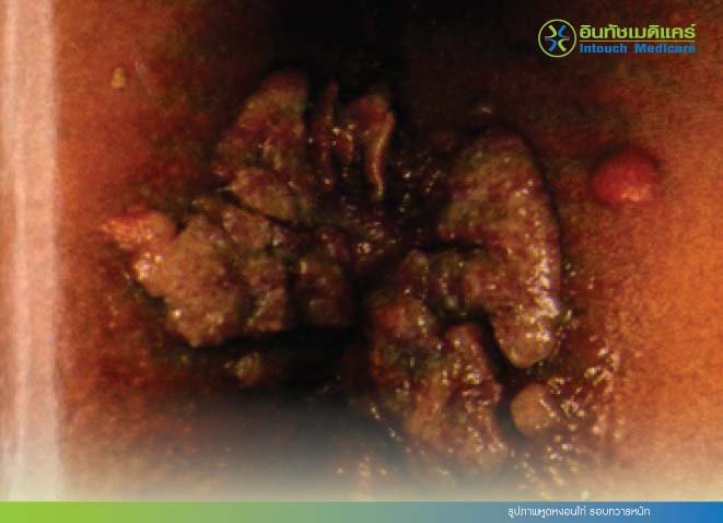 รูปภาพหูดหงอนไก่ รอบทวารหนัก รูปภาพหูดหงอนไก่ รอบทวารหนัก