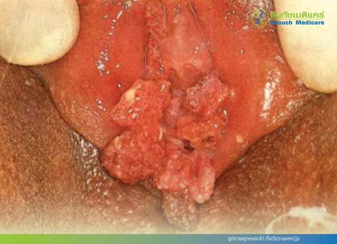 รูปภาพหูดหงอนไก่ ที่อวัยวะเพศหญิง รูปภาพหูดหงอนไก่ ที่อวัยวะเพศหญิง