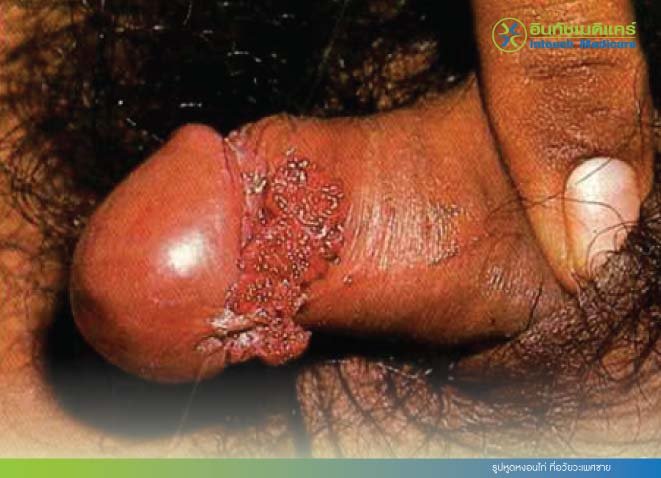 รูปหูดหงอนไก่ ที่อวัยวะเพศชาย รูปหูดหงอนไก่ ที่อวัยวะเพศชาย