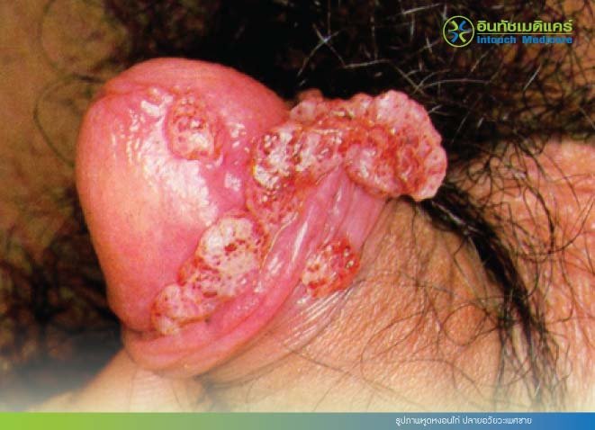 รูปภาพหูดหงอนไก่ ปลายอวัยวะเพศชาย รูปภาพหูดหงอนไก่ ปลายอวัยวะเพศชาย