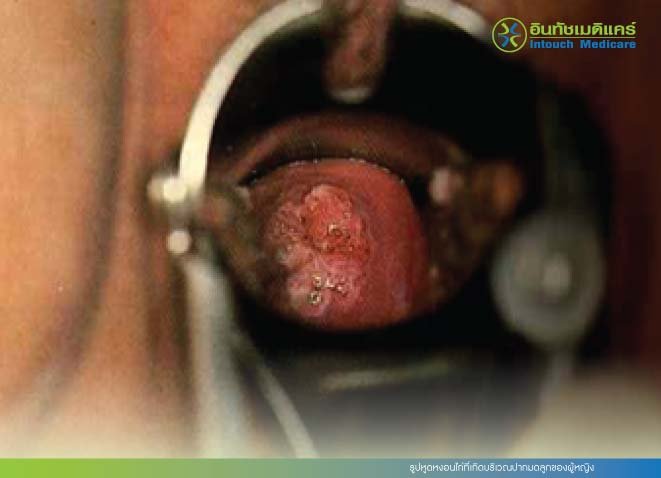 รูปหูดหงอนไก่ที่เกิดบริเวณปากมดลูกของผู้หญิง รูปหูดหงอนไก่ที่เกิดบริเวณปากมดลูกของผู้หญิง