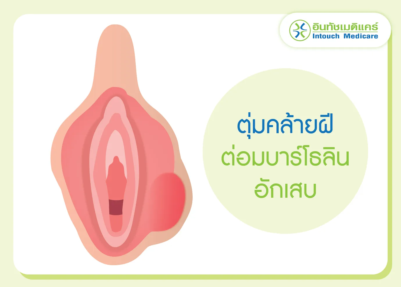 ต่อมบาร์โธลินอักเสบ มีลักษณะเป็นตุ่มคล้ายฝี ต่อมบาร์โธลินอักเสบ มีลักษณะเป็นตุ่มคล้ายฝี