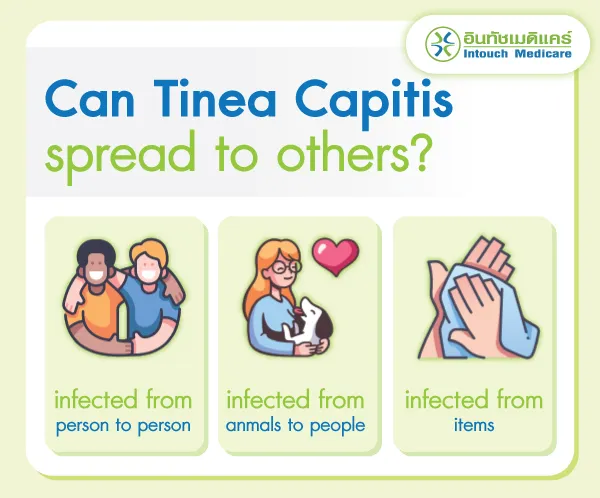 Can Tinea Capitis spread to others? Can Tinea Capitis spread to others?