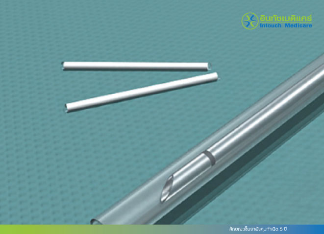 ลักษณะเข็มยาฝังคุมกำเนิด 5 ปี ลักษณะเข็มยาฝังคุมกำเนิด 5 ปี