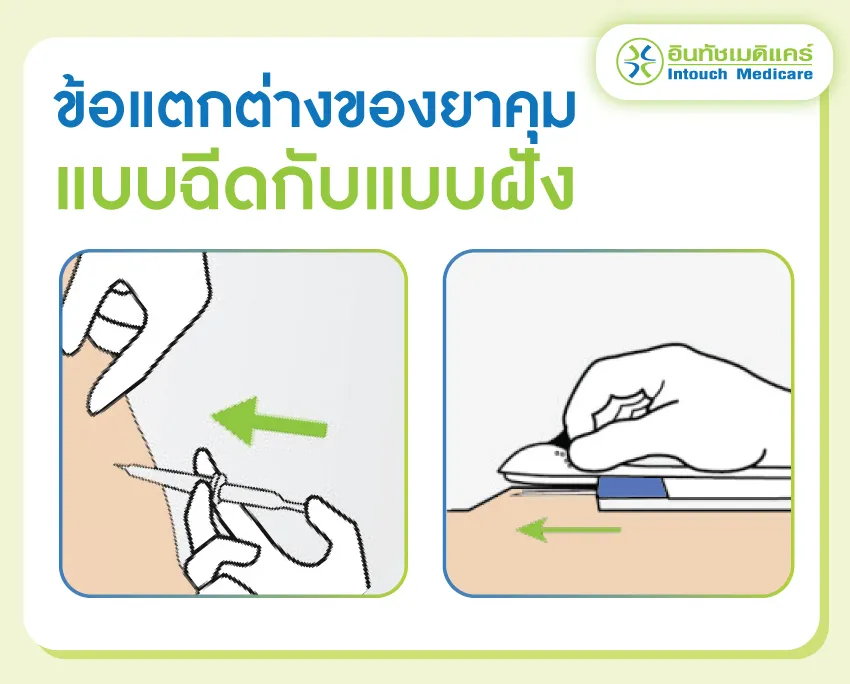 ข้อแตกต่างของยาคุมแบบฉีดกับฝังยาคม ข้อแตกต่างของยาคุมแบบฉีดกับฝังยาคม