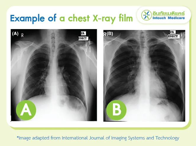 Example of a chest X-ray film. Example of a chest X-ray film.