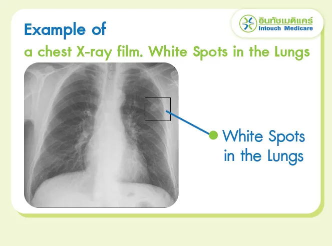 Example of a chest X-ray film. White Spots in the Lungs Example of a chest X-ray film. White Spots in the Lungs