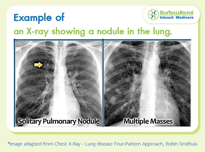 Example of an X-ray showing a nodule in the lung. Example of an X-ray showing a nodule in the lung.