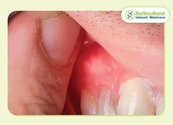 อาการของฝีที่อวัยวะภายใน อาการของฝีที่อวัยวะภายใน