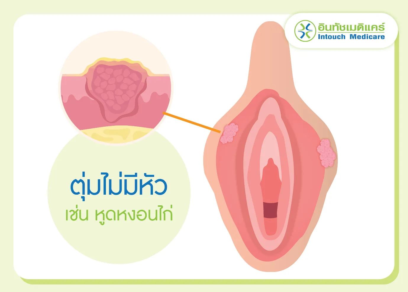 ตุ่มไม่มีหัวที่อวัยวะเพศหญิง เช่น หูดหงอนไก่