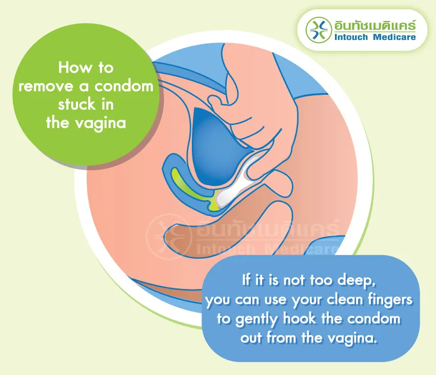 How to remove a condom stuck in the vagina How to remove a condom stuck in the vagina