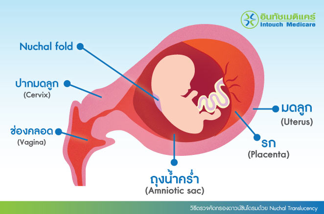 วิธีตรวจคัดกรองดาวน์ซินโดรมด้วย Nuchal Translucency วิธีตรวจคัดกรองดาวน์ซินโดรมด้วย Nuchal Translucency