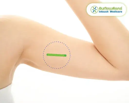 ฝังยาคุม มีข้อดี ข้อเสีย ฝังยาคุม มีข้อดี ข้อเสีย