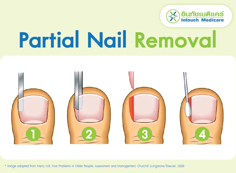 Partial Nail Removal Partial Nail Removal