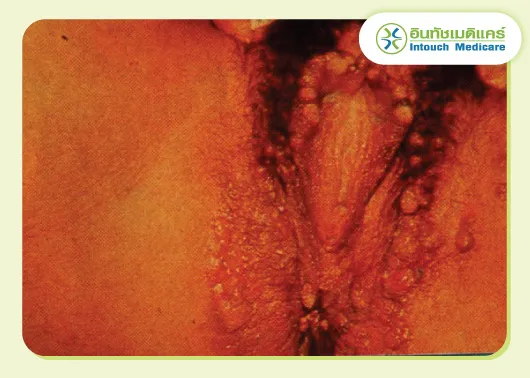 ภาพโรคซิฟิลิสที่อวัยวะเพศ ภาพโรคซิฟิลิสที่อวัยวะเพศ