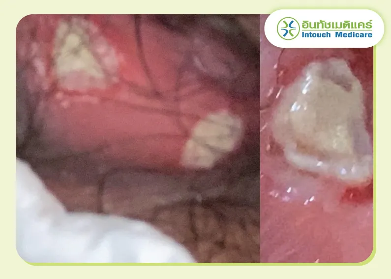 รูปภาพซิฟิลิสที่อวัยวเพศ รูปภาพซิฟิลิสที่อวัยวเพศ