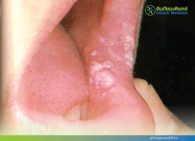 รูปภาพหูดหงอนไก่ที่ปาก รูปภาพหูดหงอนไก่ที่ปาก