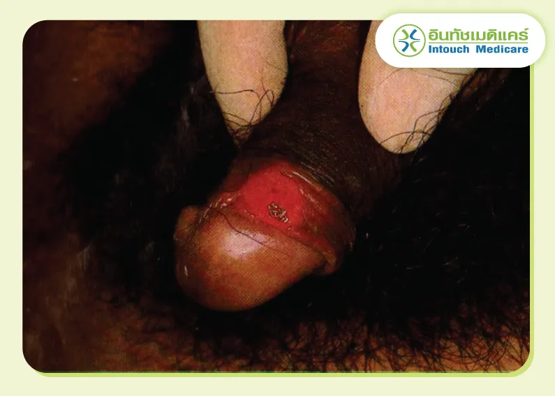 รูปภาพแผลซิฟิลิสอวัยวะเพศชาย รูปภาพแผลซิฟิลิสอวัยวะเพศชาย