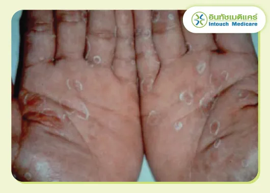 รูปภาพโรคซิฟิลิสผื่นที่ฝ่ามือ รูปภาพโรคซิฟิลิสผื่นที่ฝ่ามือ