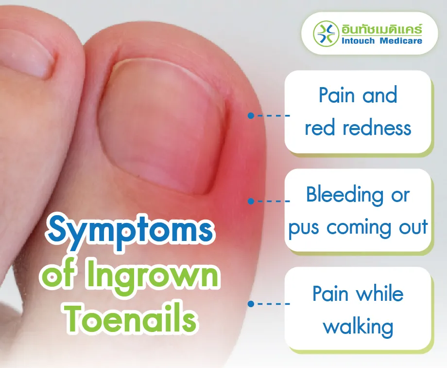 Symptoms of Ingrown Toenails. Symptoms of Ingrown Toenails.