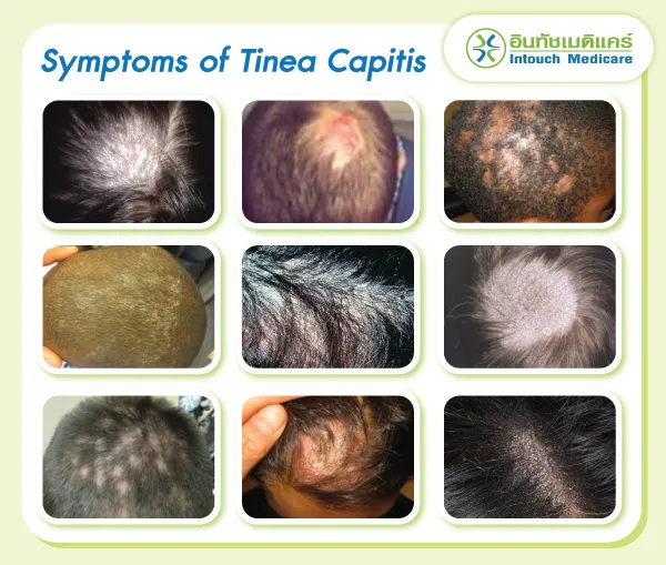 Symptoms of Tinea Capitis Symptoms of Tinea Capitis