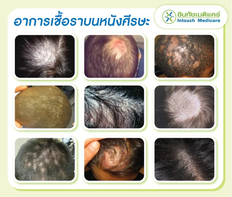 อาการของเชื้อราบนหนังศีรษะ