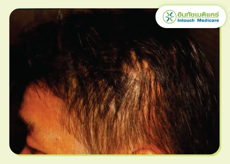 ผู้ป่วยซิฟิลิสผมร่วงเป็นหย่อมๆ ผู้ป่วยซิฟิลิสผมร่วงเป็นหย่อมๆ