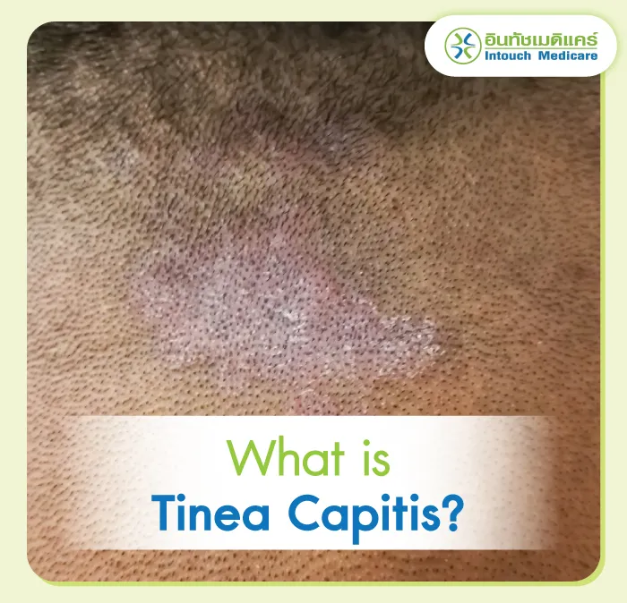 Tinea Capitis How to treat itchy head and dandruff? Tinea Capitis How to treat itchy head and dandruff?