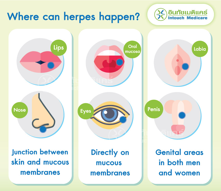 Where can herpes happen? Where can herpes happen?