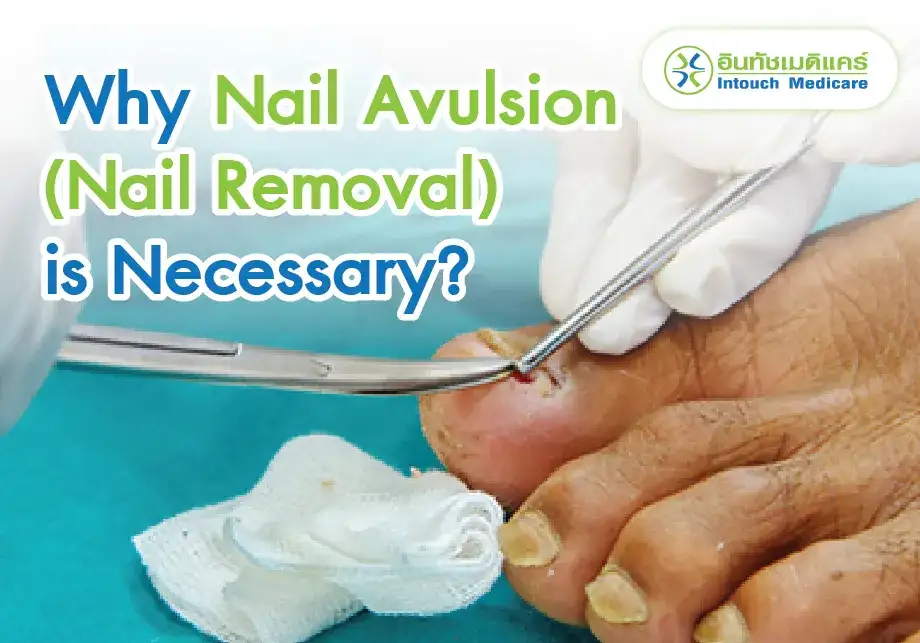 Why Nail Avulsion (Nail Removal) is Necessary? Why Nail Avulsion (Nail Removal) is Necessary?