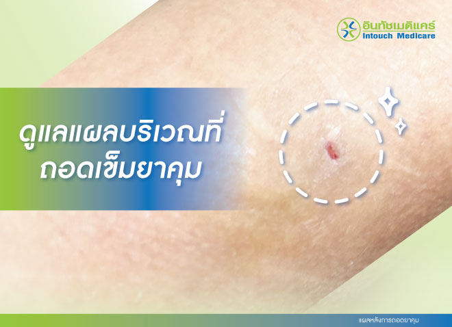 แผลหลังการถอดยาคุม แผลหลังการถอดยาคุม