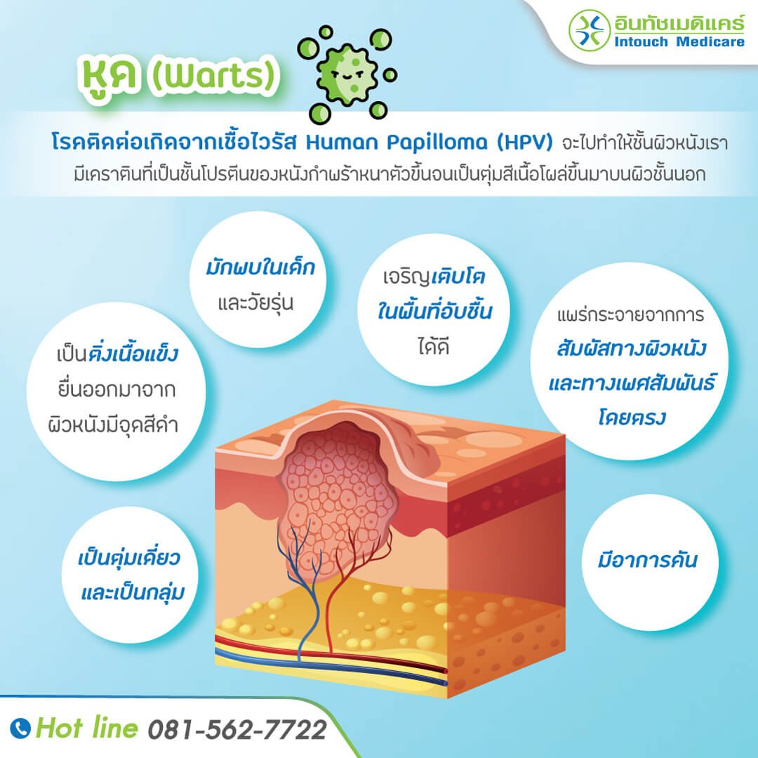 หูด item-สำคัญ