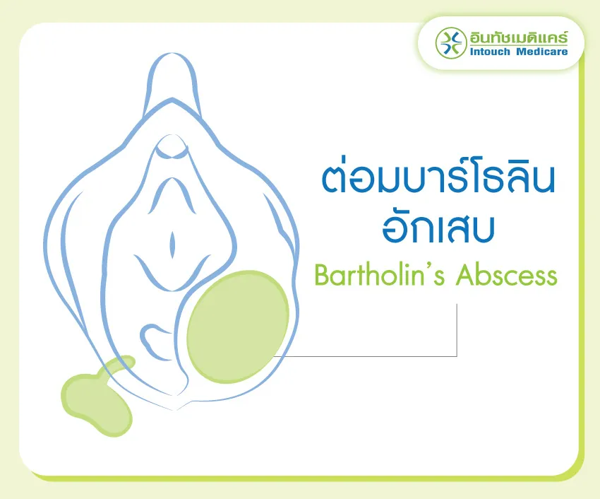 ต่อมบาร์โธลินอักเสบ เกิดจากอะไร