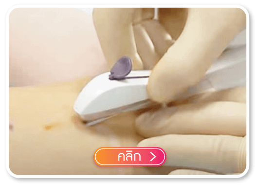 คลิกเพื่อรับบริการ ฝังยาคุม ถอดยาคุม คลิกเพื่อรับบริการ ฝังยาคุม ถอดยาคุม