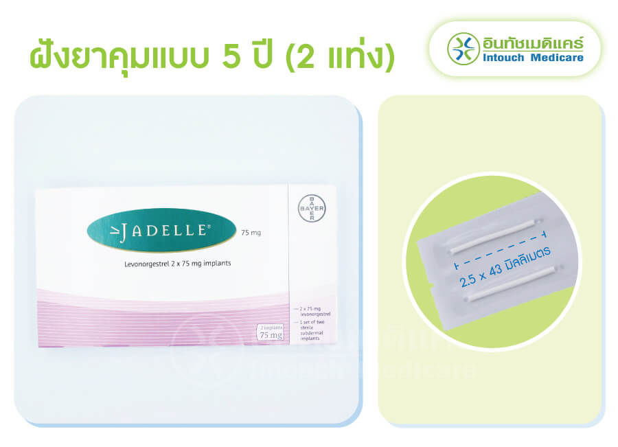 ฝังยาคุมกำเนิด 5 ปี ยี่ห้อ Jadelle (จาเดลล์)