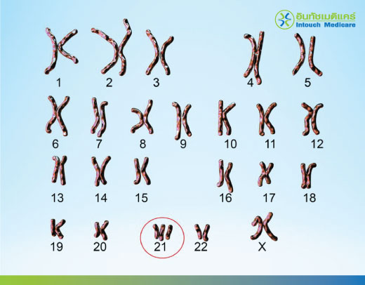 ตรวจดาวน์ซินโดรม คืออะไร