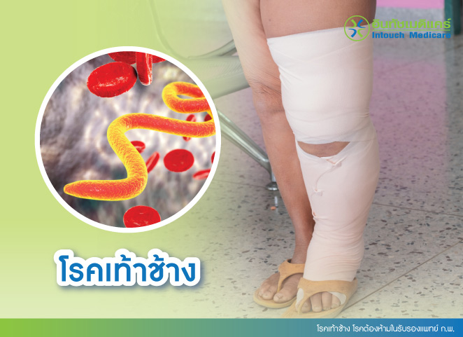 โรคเท้าช้าง โรคต้องห้ามในรับรองแพทย์ ก.พ. โรคเท้าช้าง โรคต้องห้ามในรับรองแพทย์ ก.พ.