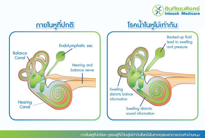 In normal ears and ears of people with unequal water in the ears, which is one of the causes of vertigo headaches.