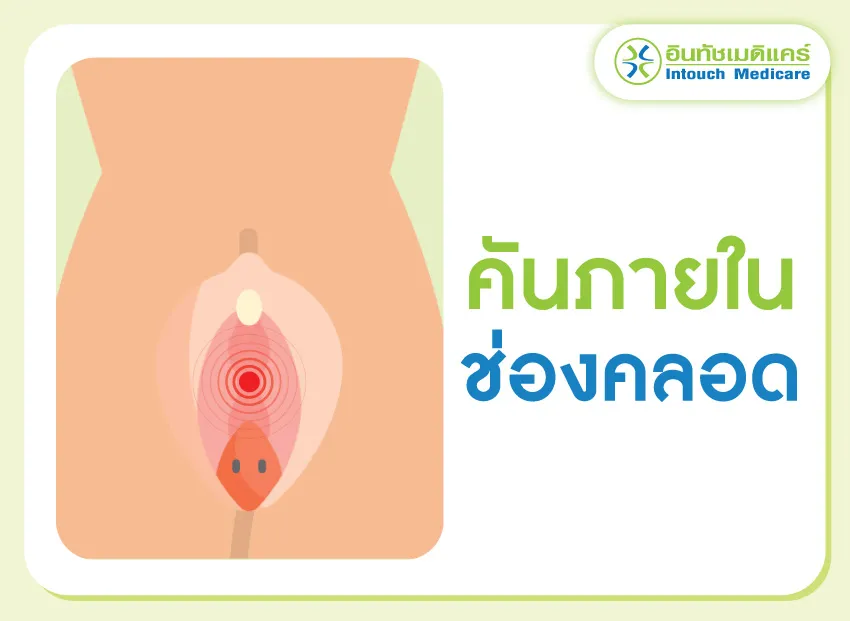 คันภายในช่องคลอด คันภายในช่องคลอด