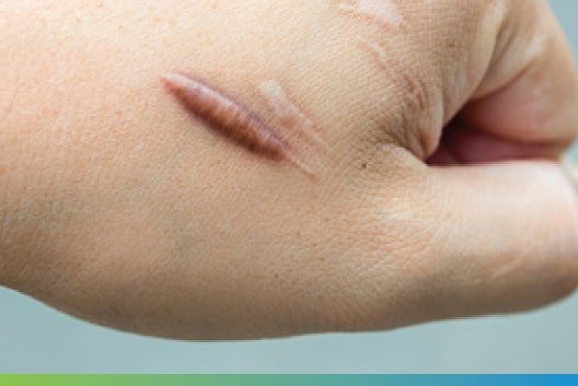 keloid ခီလွယ်