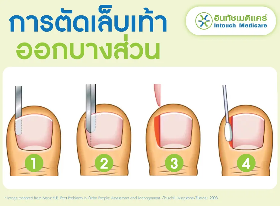 การตัดเล็บเท้าที่ขบออกบางส่วน