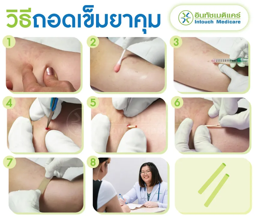 วิธีถอดเข็มยาคุม วิธีถอดเข็มยาคุม