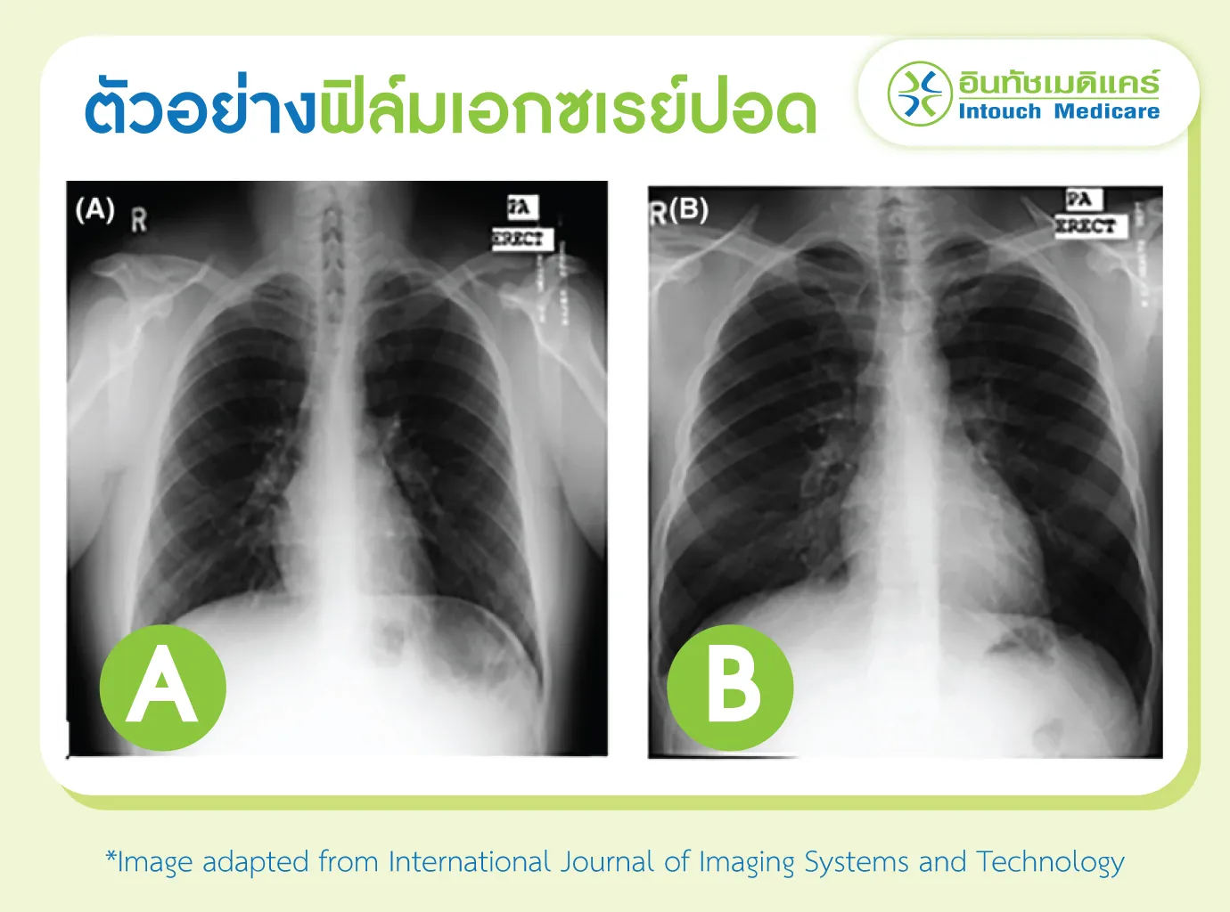 ภาพตัวอย่างฟิล์มเอกซเรย์ปอด