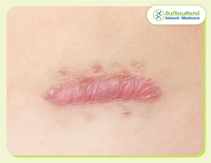 จี้หูด ฉีดคีลอยด์ ตัดติ่งเนื้อ รักษาแผลเป็น จี้หูด ฉีดคีลอยด์ ตัดติ่งเนื้อ รักษาแผลเป็น