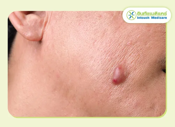 อาการของฝีที่ผิวหนัง อาการของฝีที่ผิวหนัง