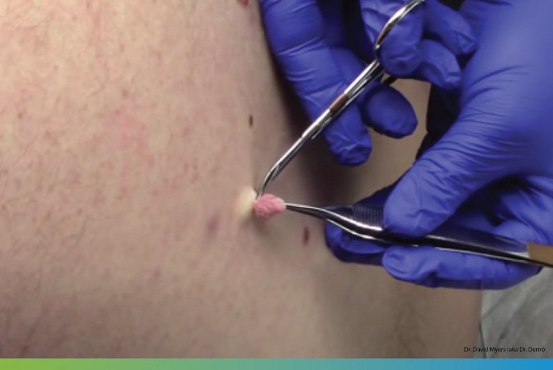 skin-tags ငါးမျက်စိ