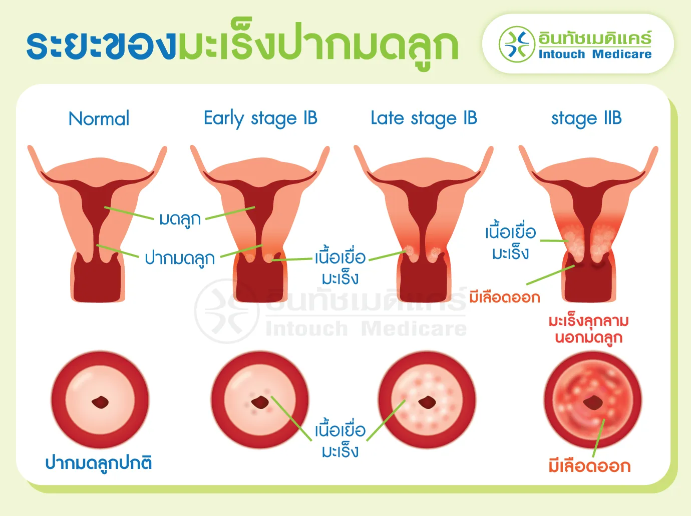 ระยะของมะเร็งปากมดลูก